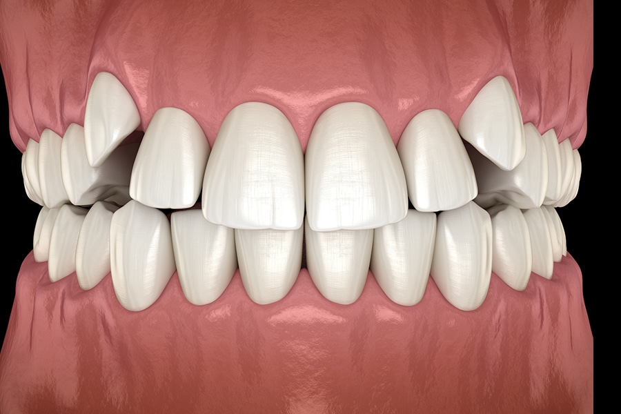 Crowding of Teeth Photo