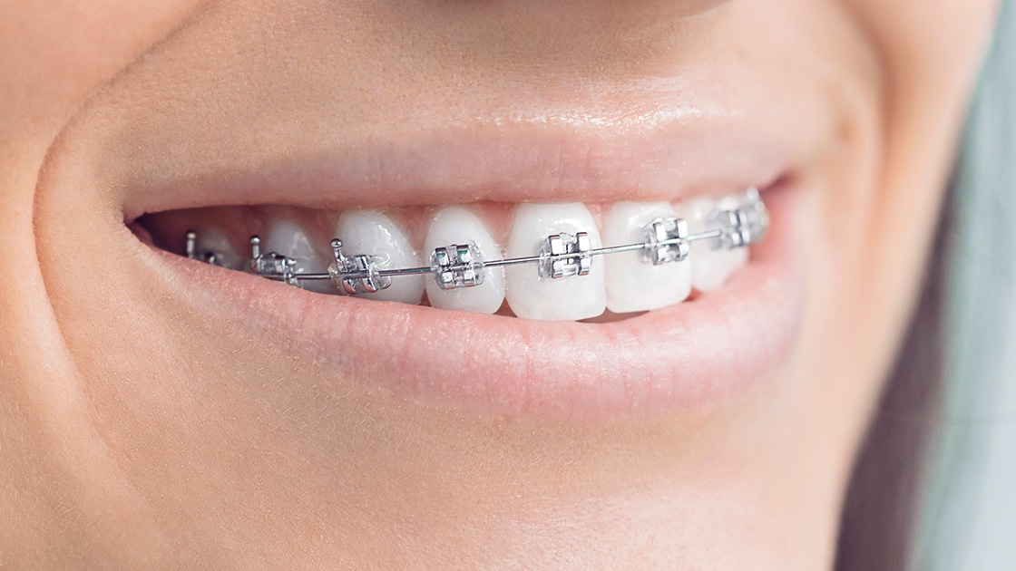 Metal Braces Photo